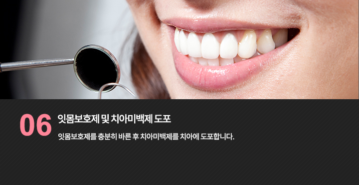 잇몸보호제를 충분히 바른 후 치아미백제를 치아에 도포합니다.